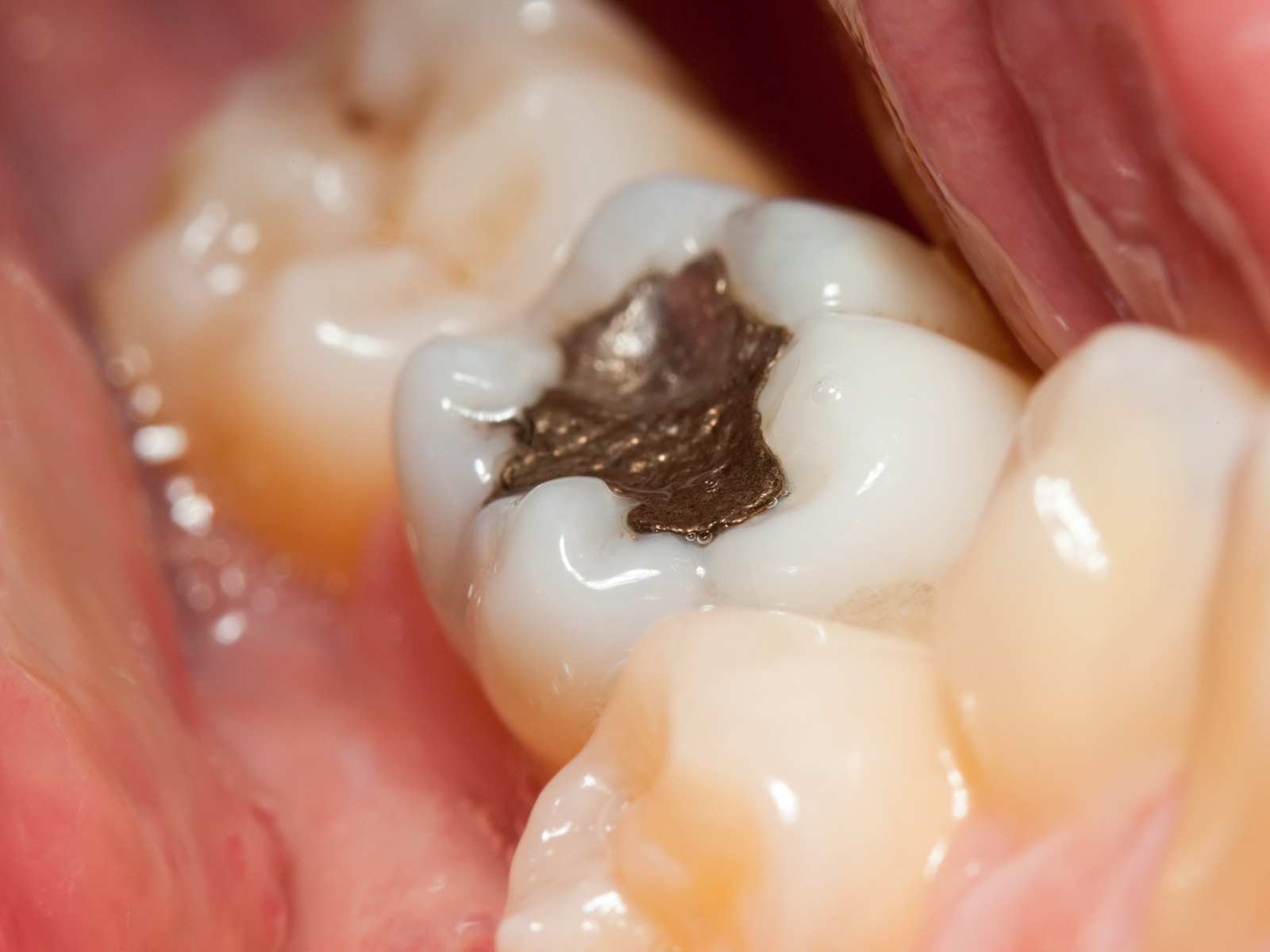 Can Dental Cavities Predict Future Health Problems?