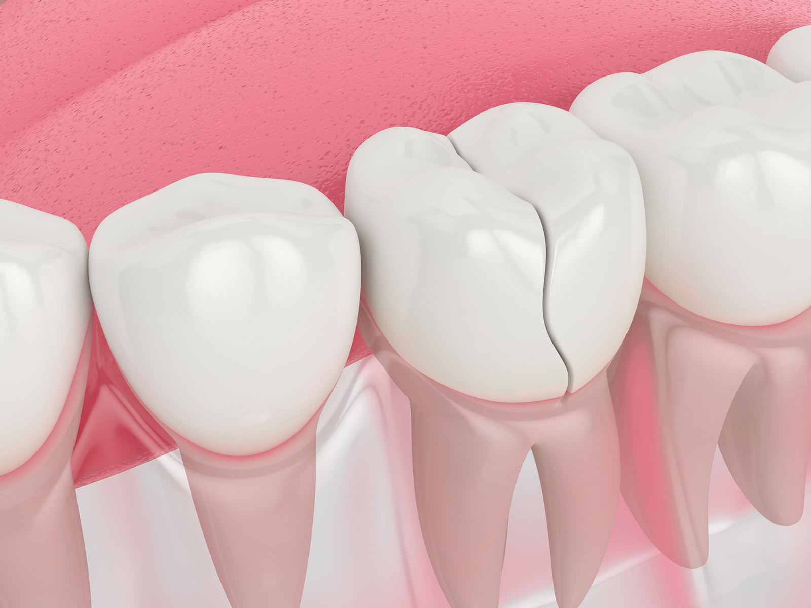 Why You Shouldn’t Ignore Cracked Teeth!