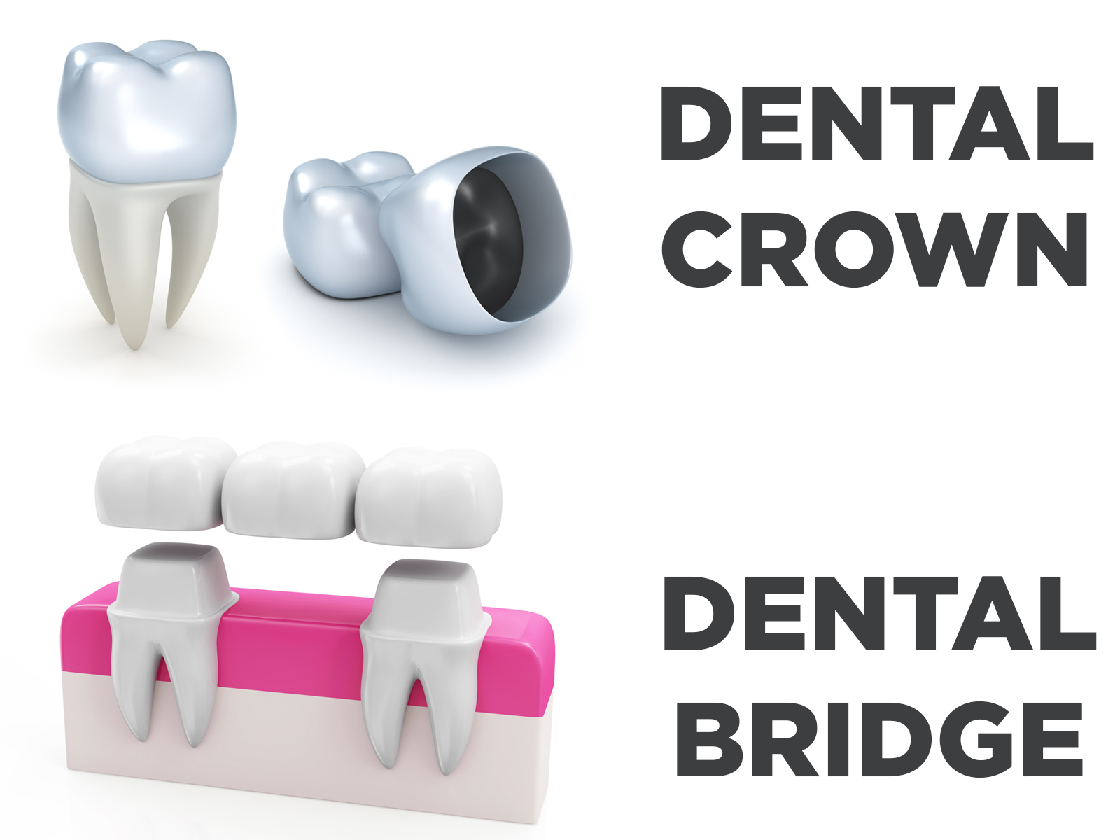 The Importance of Crowns and Bridges