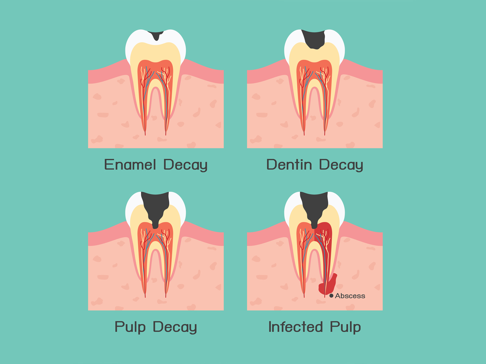 Does Oatmeal Cause Tooth Decay?