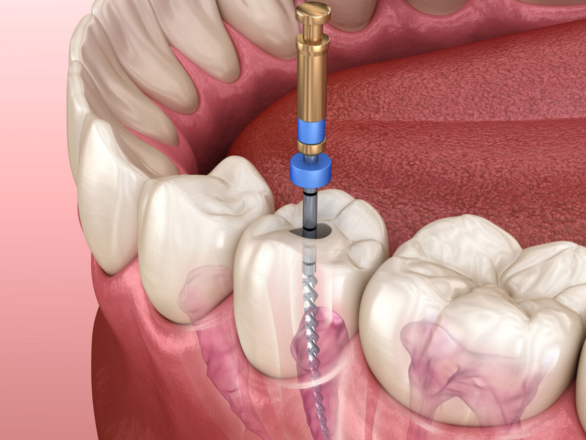 How Painful is a Root Canal Without Anesthesia  