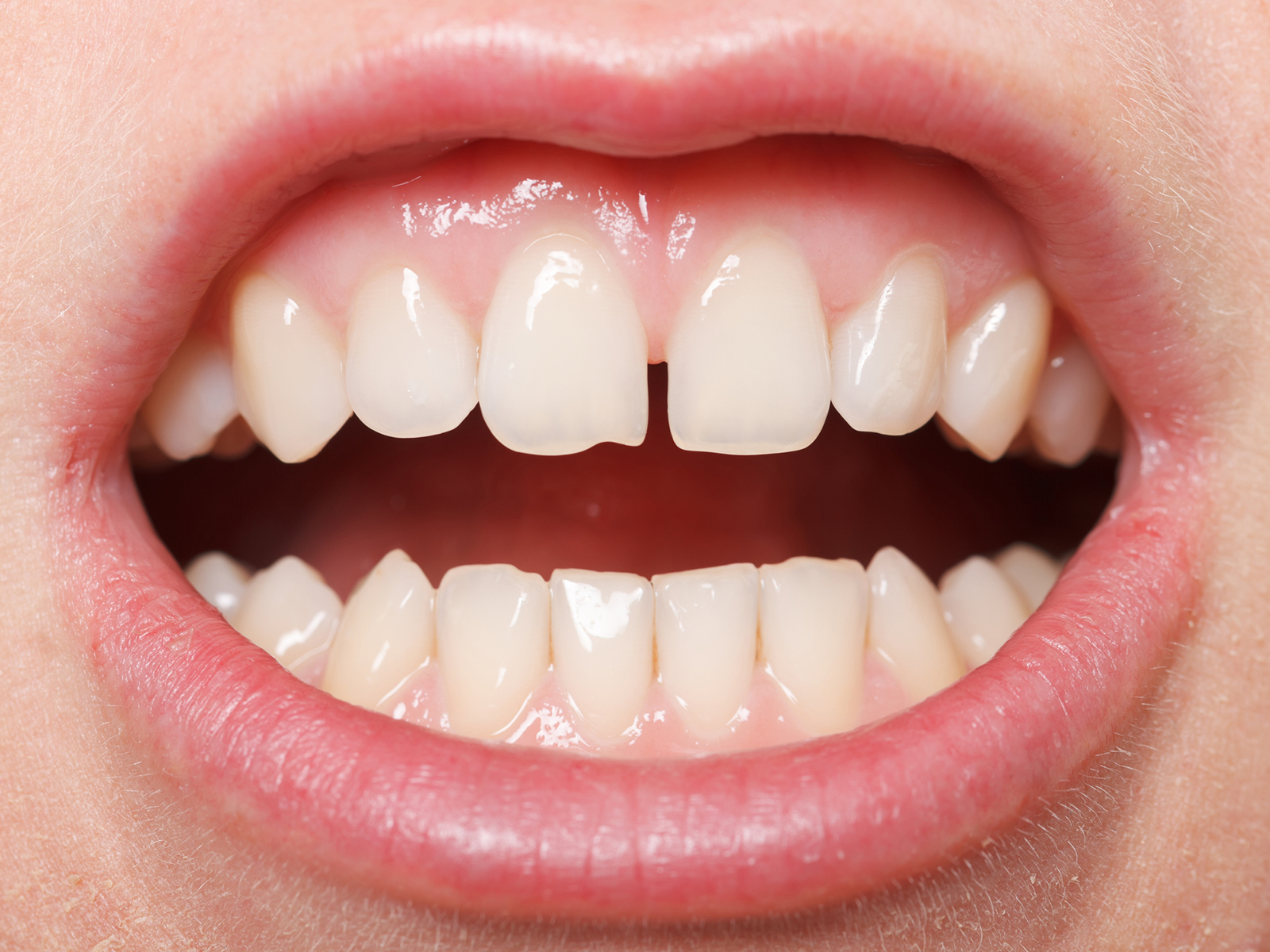 Options for Filling Tooth Gaps