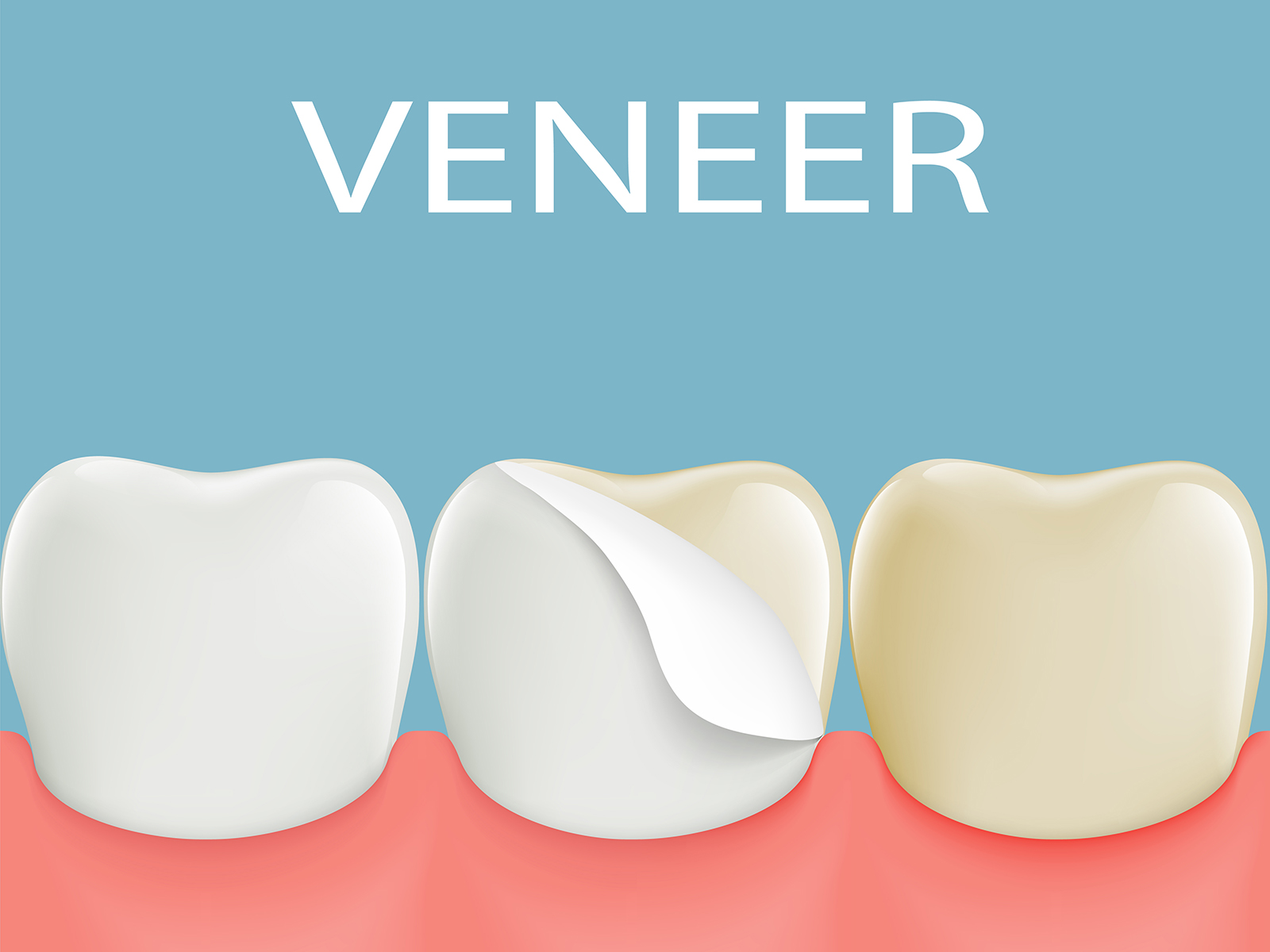 What Is A Veneer, And Why Is It Required?