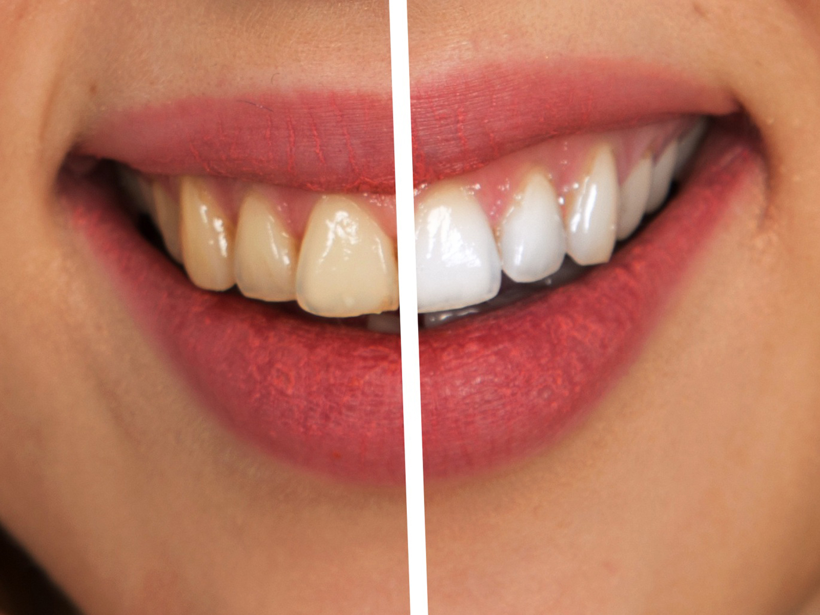 Treatment for Discolored or Yellowed Teeth