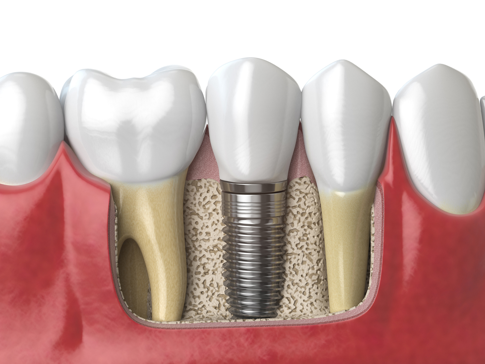 Are dental implants glued in?