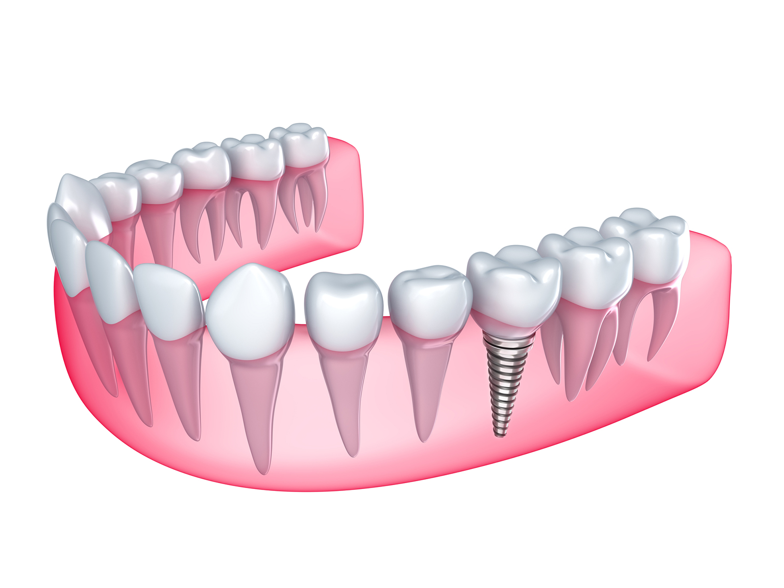 How Much Does a 4 in 1 Dental Implant Cost?