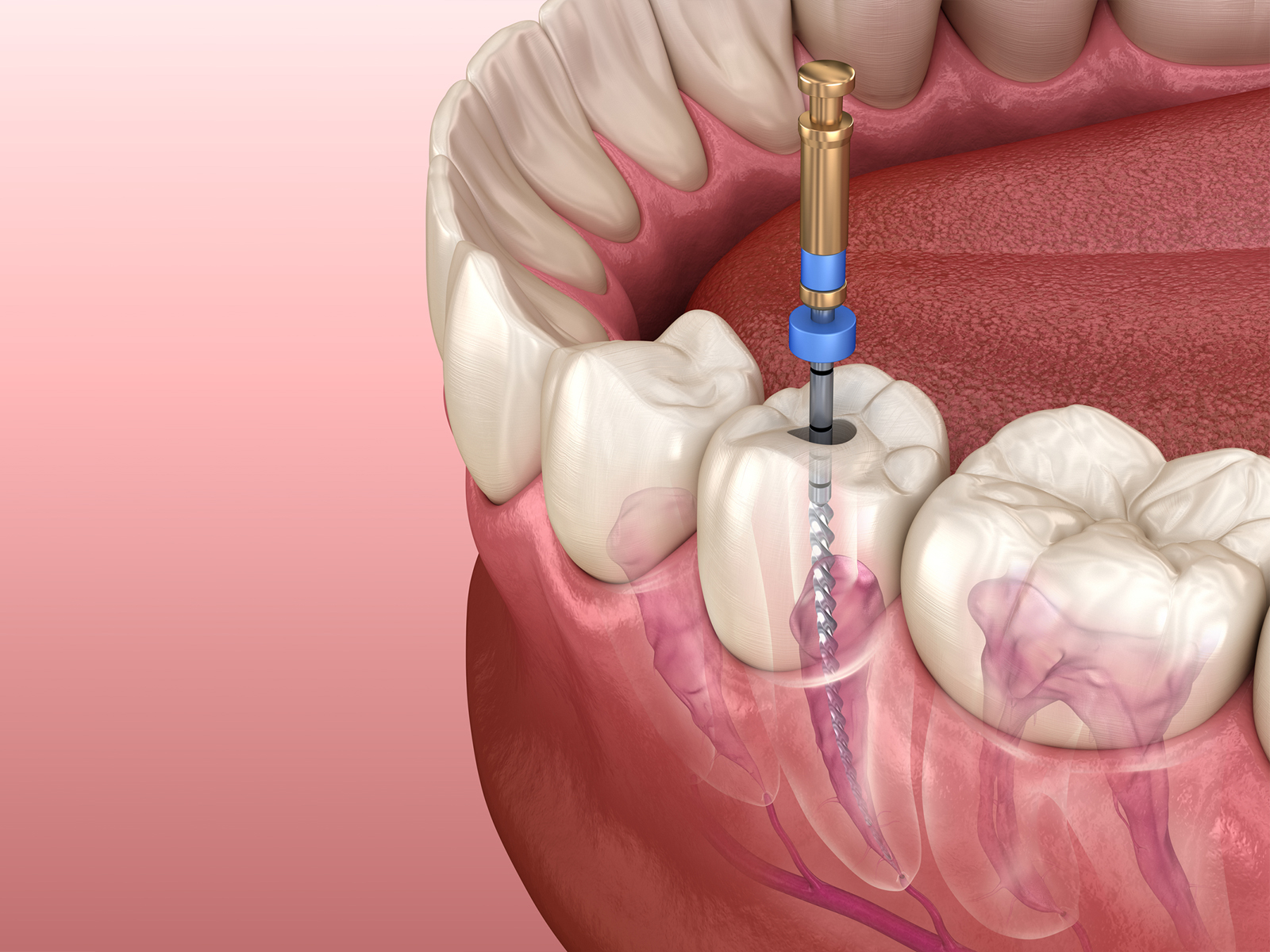 Can a Root Canal be Done More Than Once on the Same Tooth?