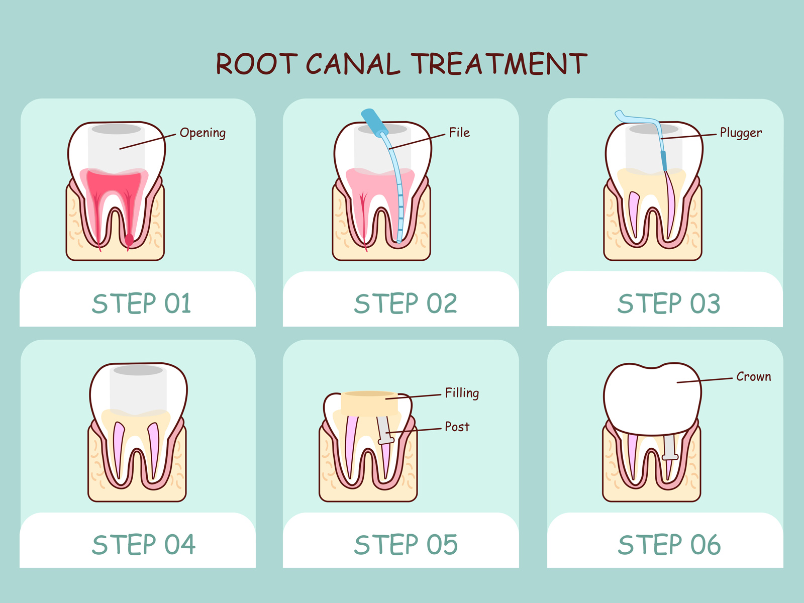 Does a Big Cavity Mean Root Canal?
