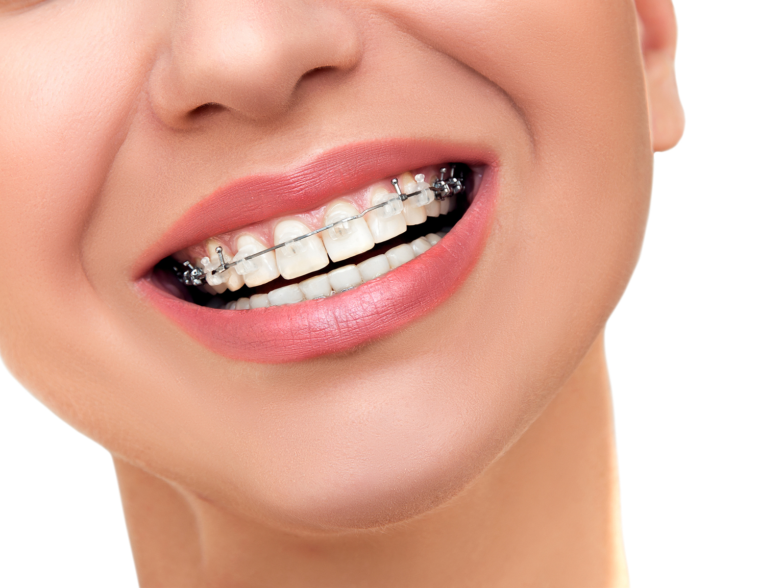 What’s the shortest amount of time for braces?