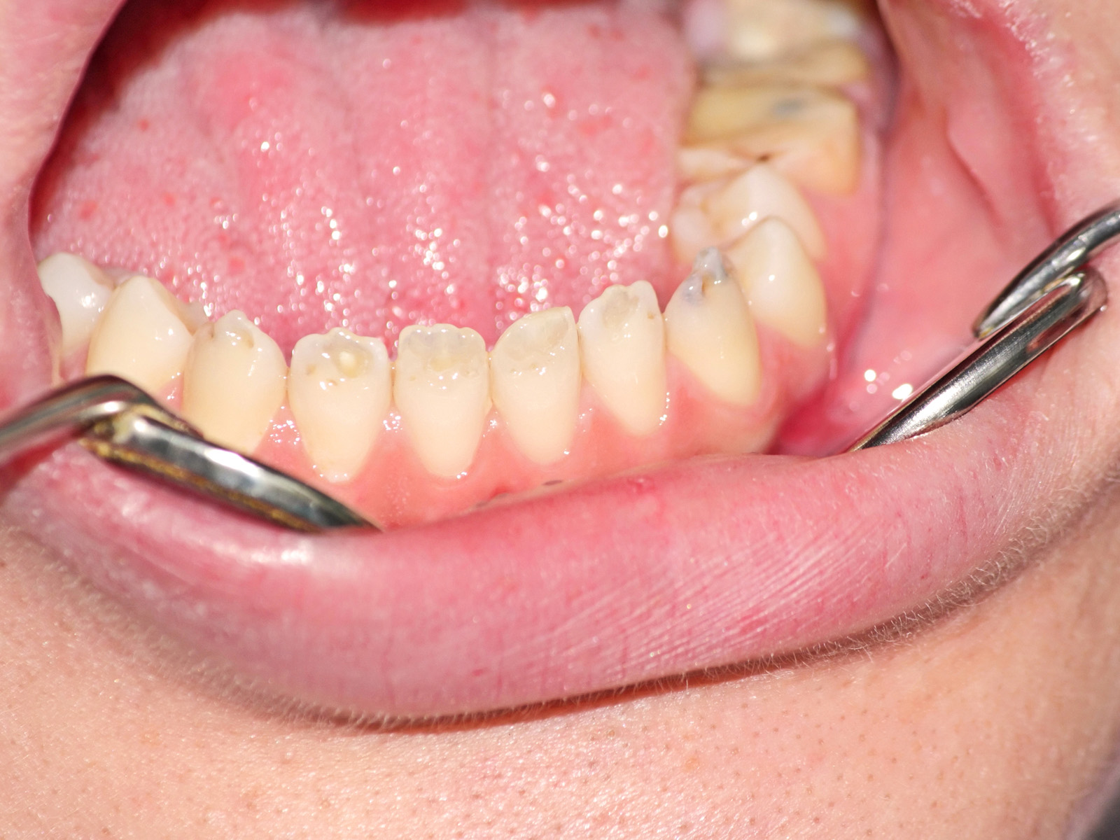 What Causes Chalky Teeth And How To Get Rid Of Them?