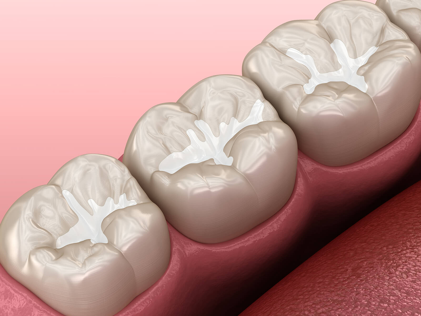 How Can You Solve The Dental Sealants Issues?