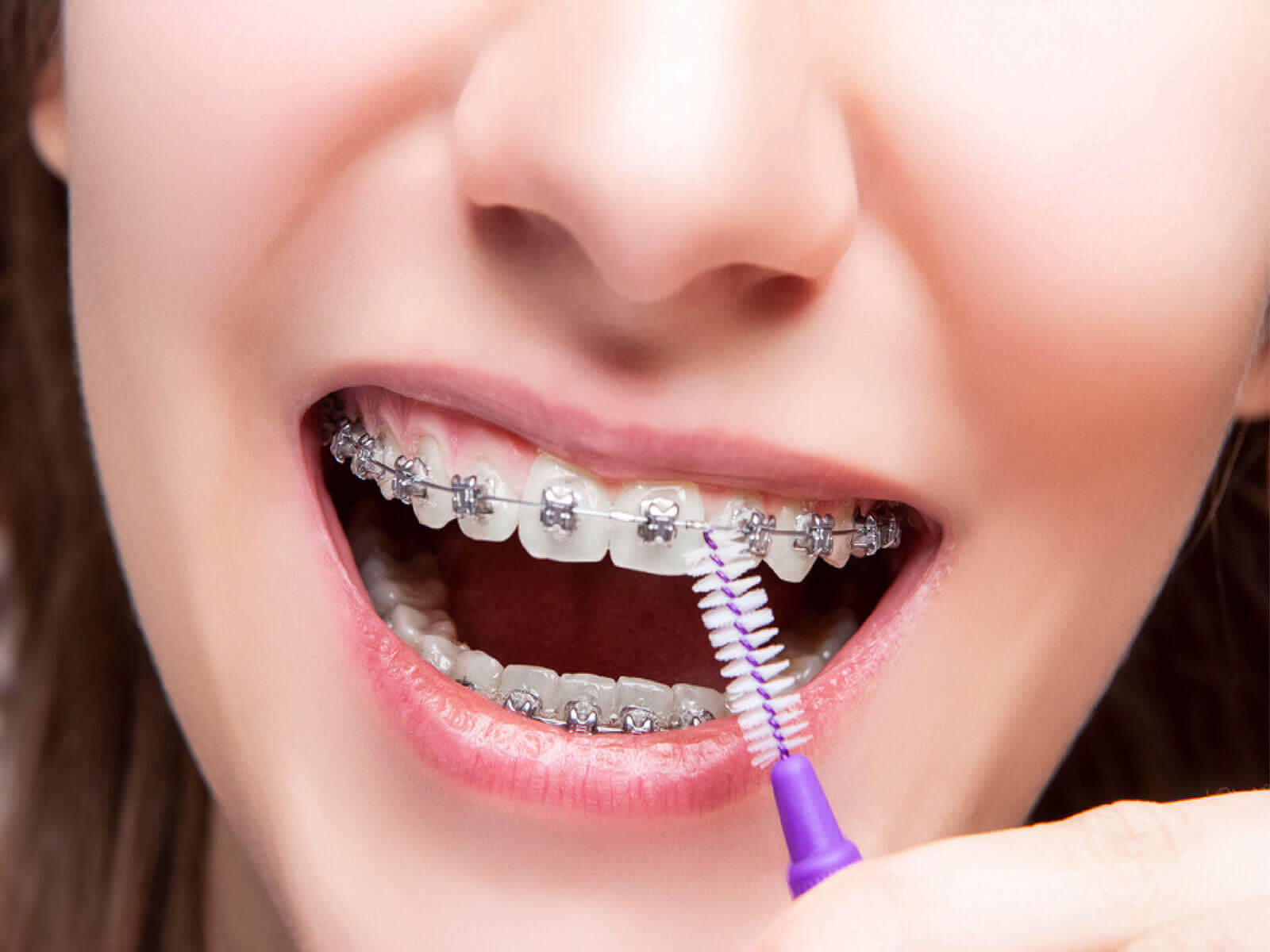 Understanding Dental Bonding For Aesthetic Tooth Repairs