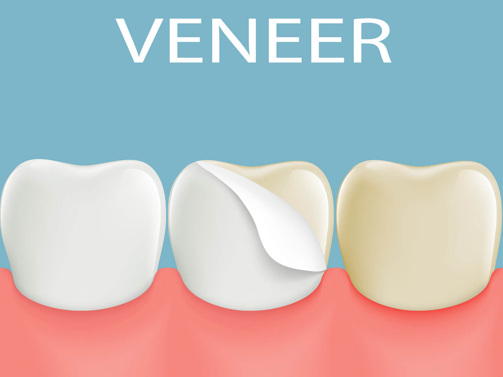 How Veneers Can Transform Your Smile