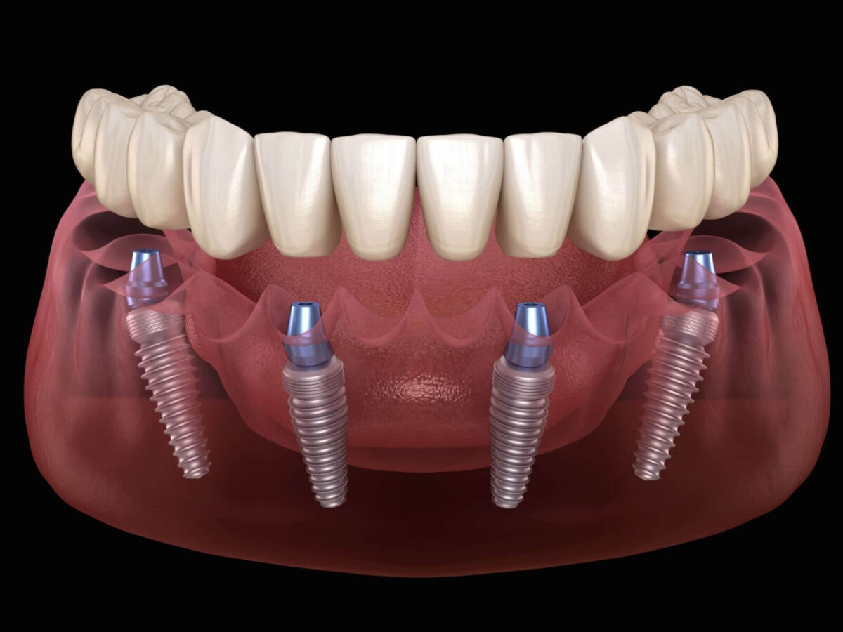 A Complete Guide To Cleaning All-on-4 Dental Implants