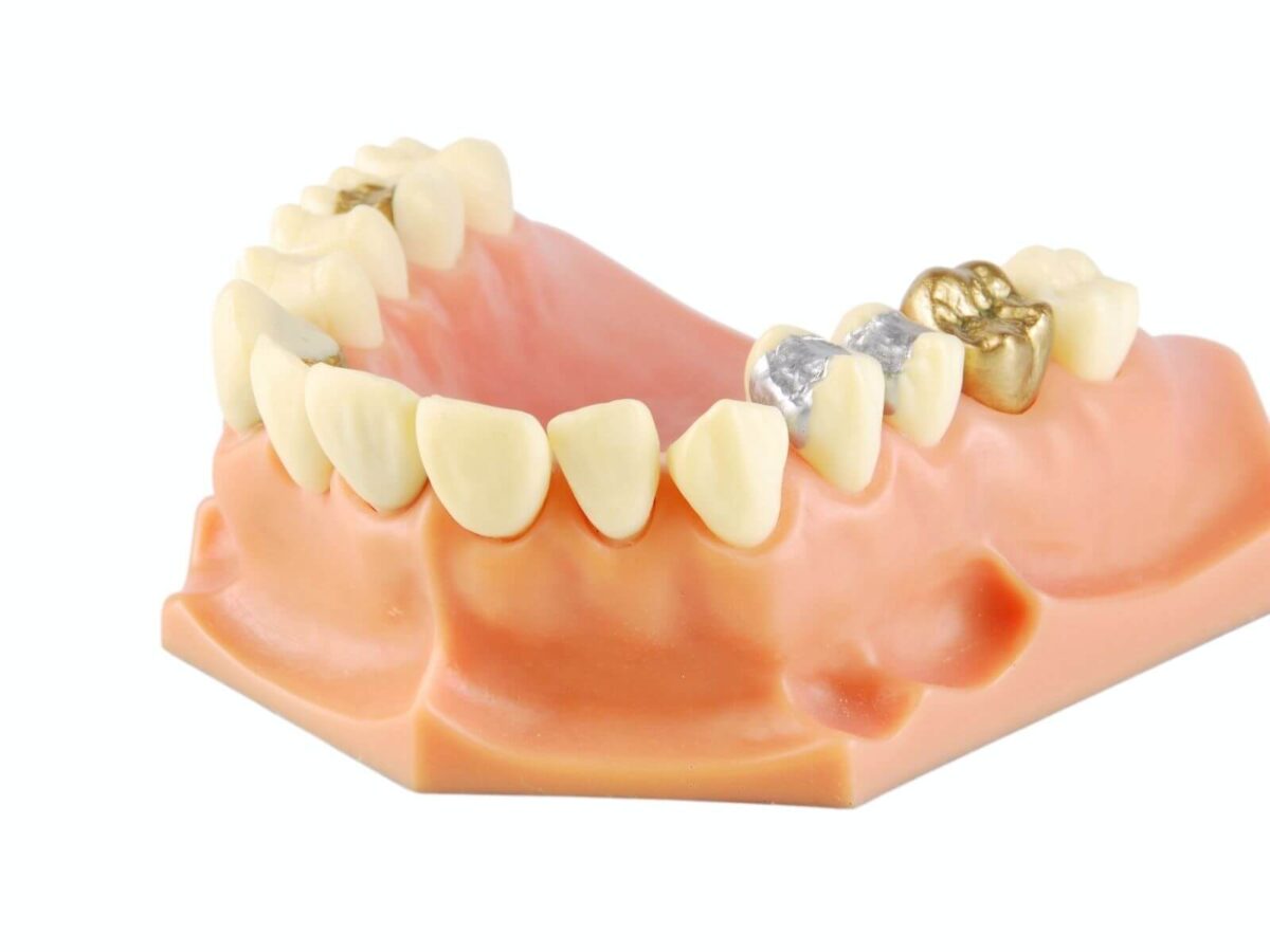 Signs Your Dental Filling Needs To Be Replaced