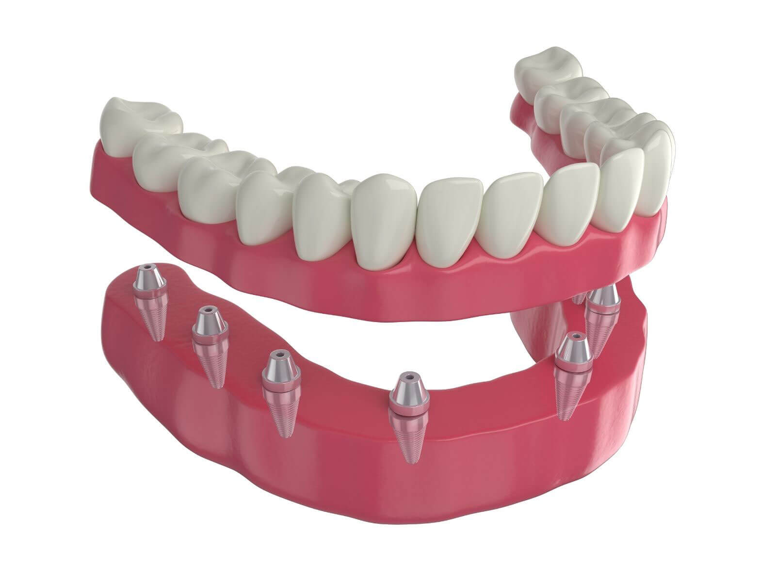 5 Types of Dental Implants: Which One Is Right for You?