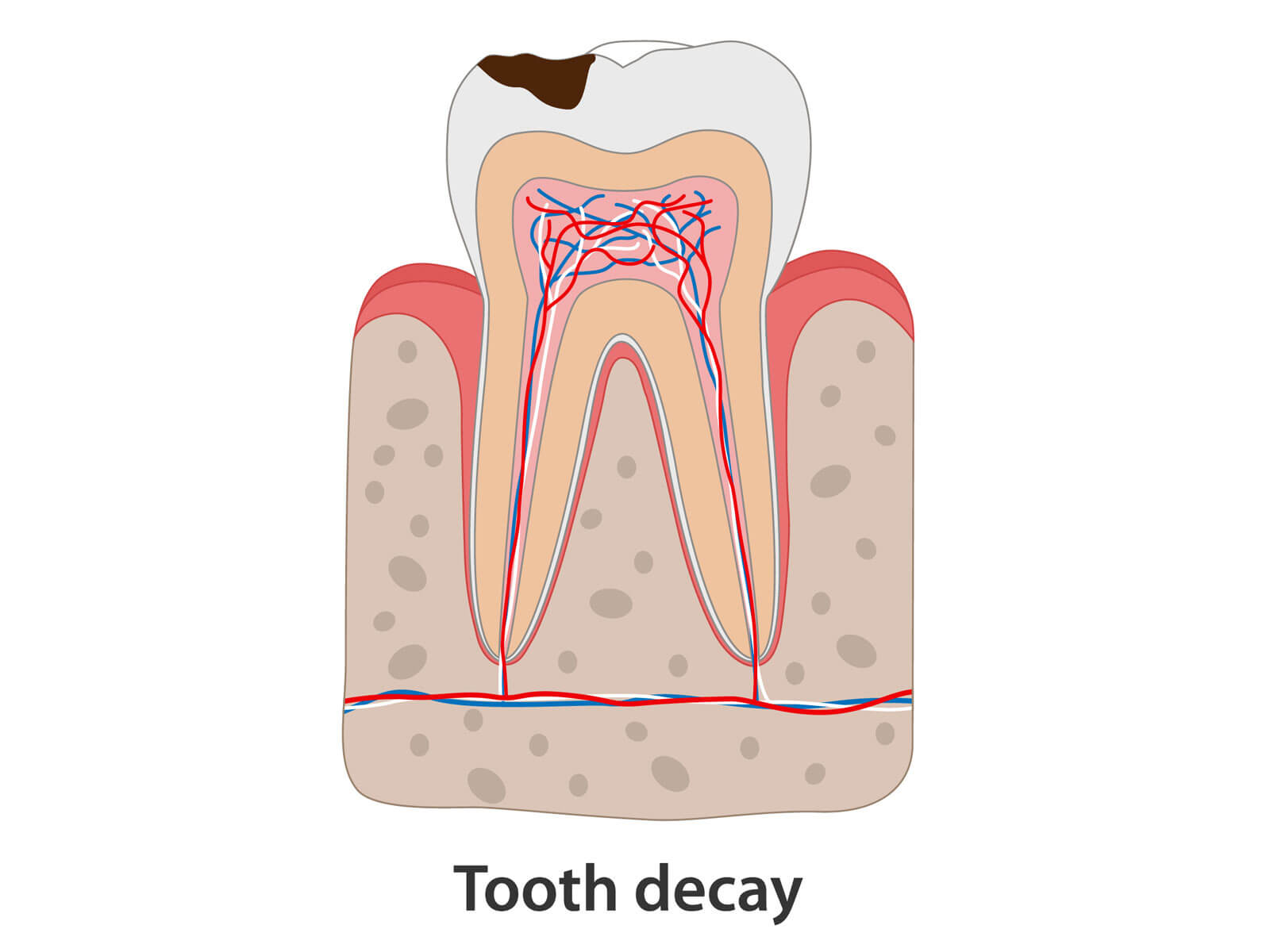 Cavities & Tooth Decay: Symptoms, Causes, and Effective Treatments