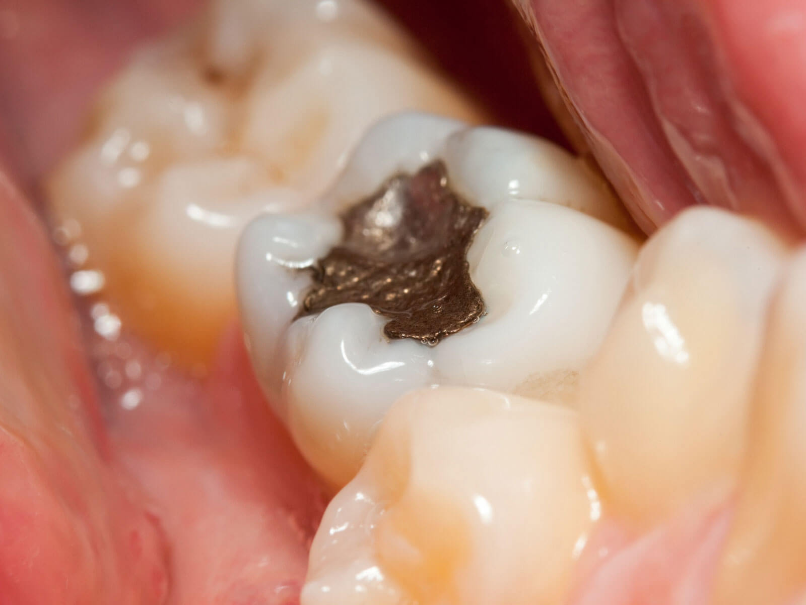 How Long Does a Tooth Filling Last?