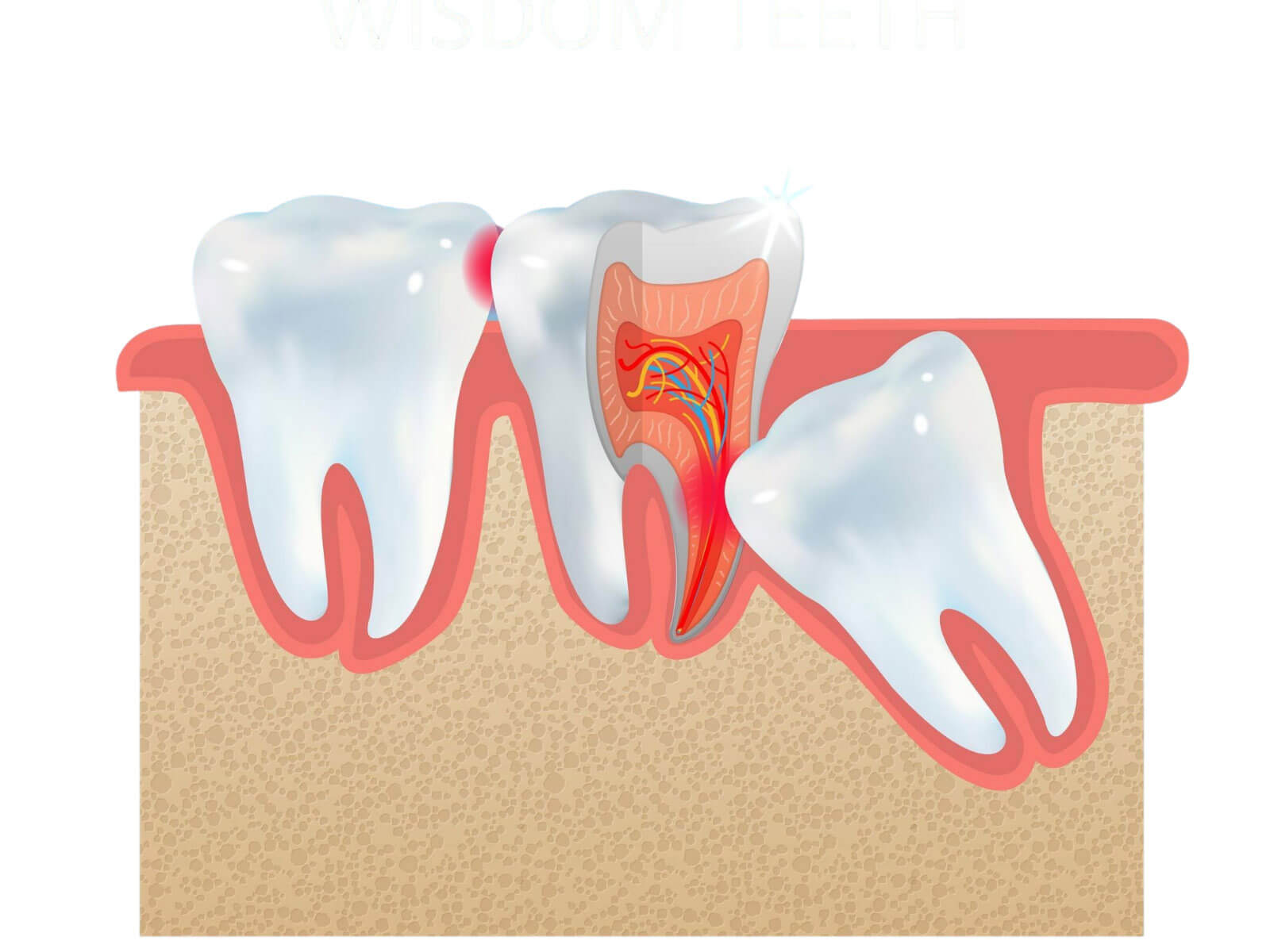 Impacted Wisdom Tooth: Symptoms, Causes, and Treatment