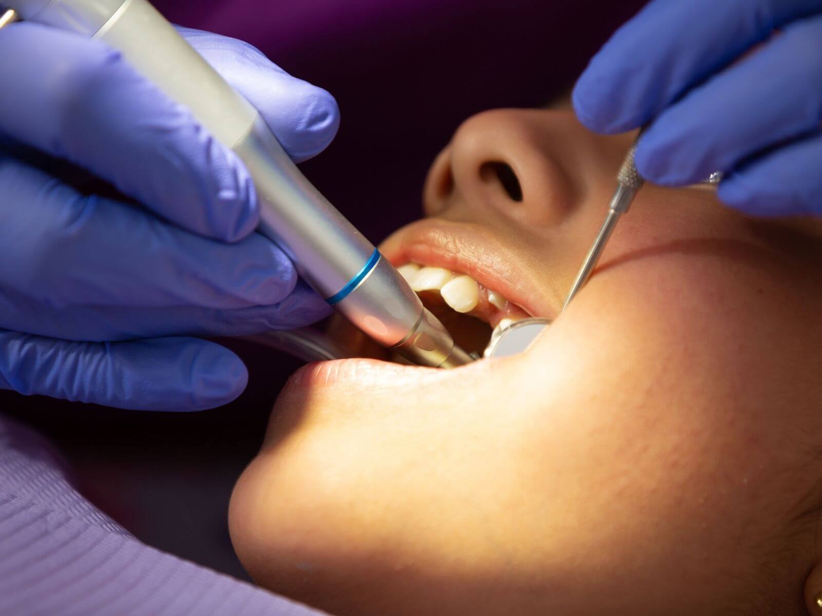 Cavity Filling Cost: What to Expect With and Without Insurance