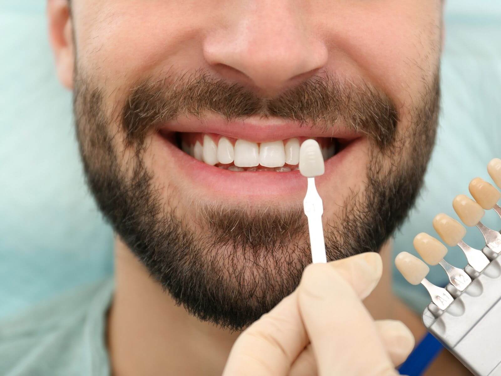 Dental Veneers Cost: Porcelain vs. Composite Price Breakdown