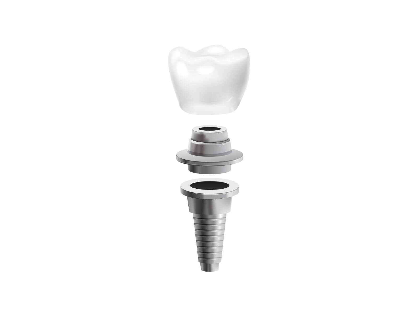 Dental Implants vs. Dental Bridges: Cost, Pros, Cons, and Which Is Better