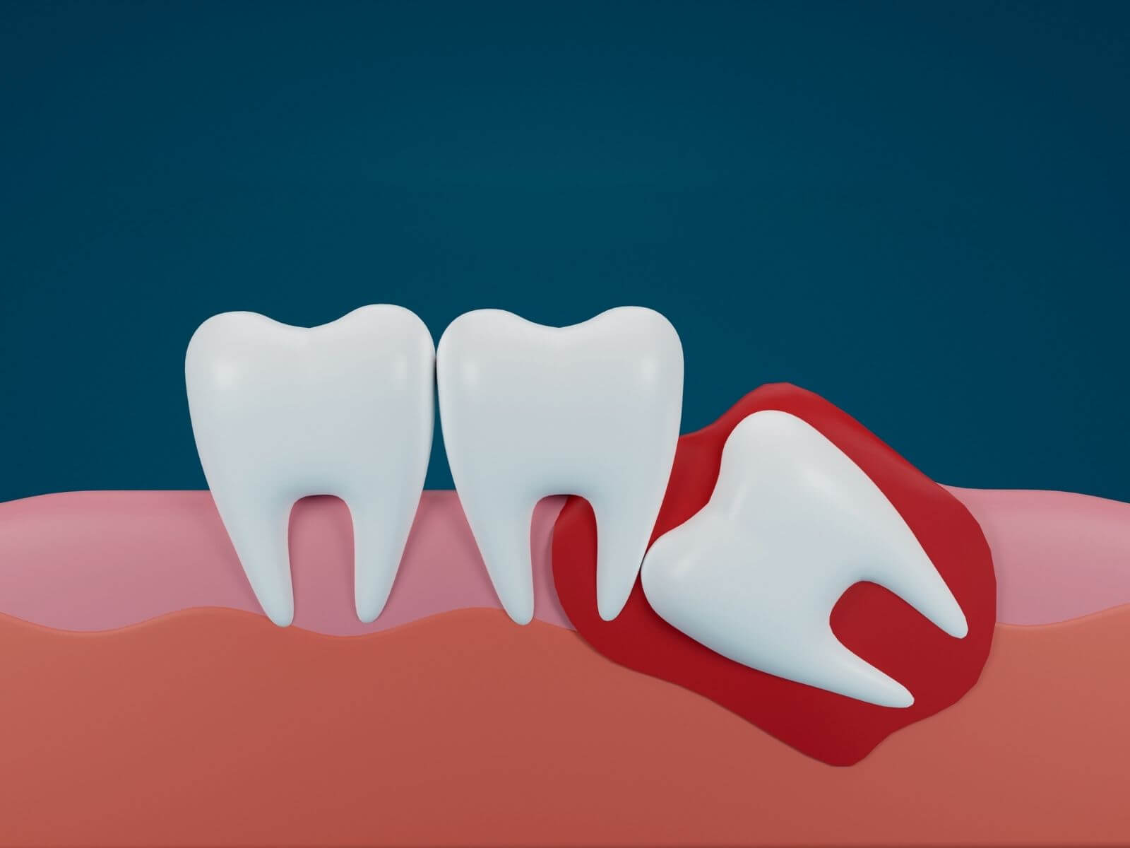 Impacted vs. Erupted Wisdom Teeth: Differences, Symptoms, and Treatment