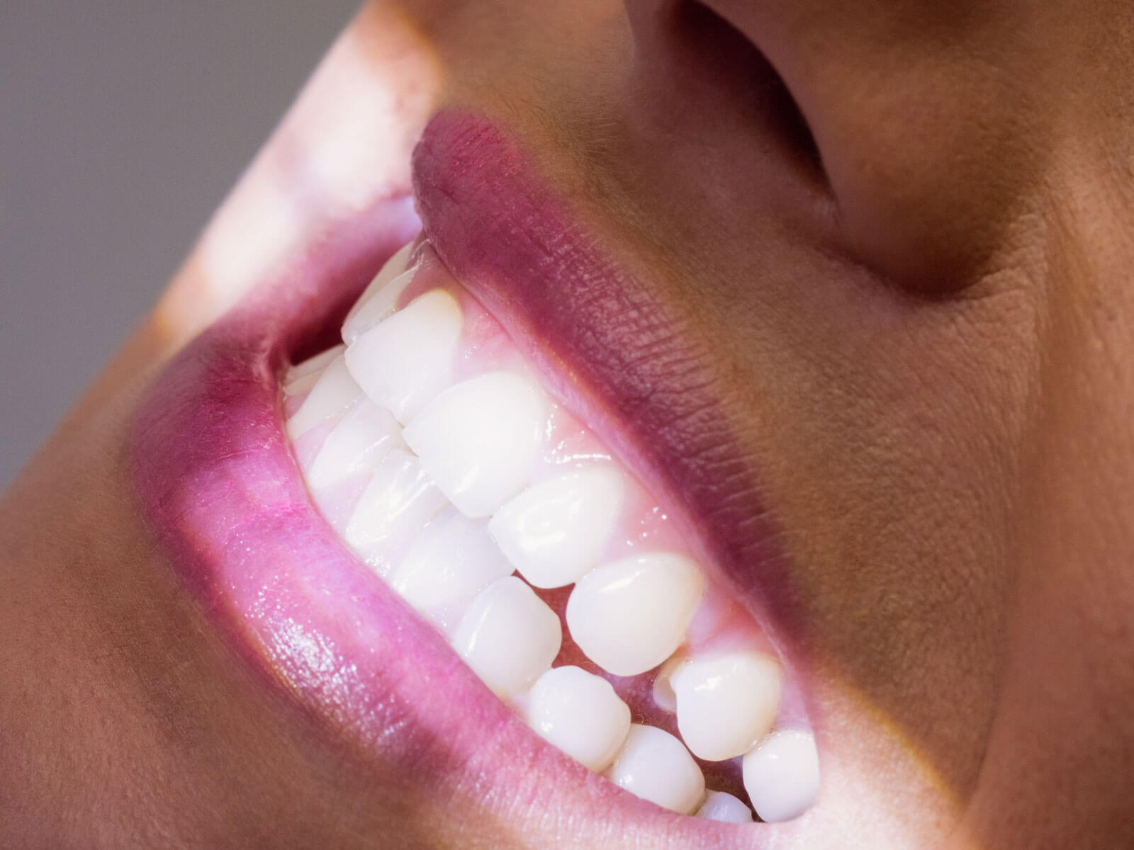 Zirconia vs. PFM Crowns: Strength, Aesthetics, Cost, and Which Is Right for You